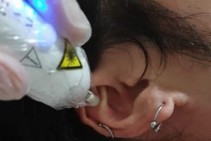 Auriculoterapia a Laser